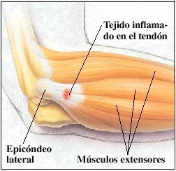 Coderas para epicondilitis (codo de tenista) - Blog sobre ortopedia de